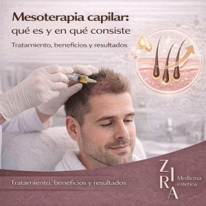 que es la mesoterapia capilar