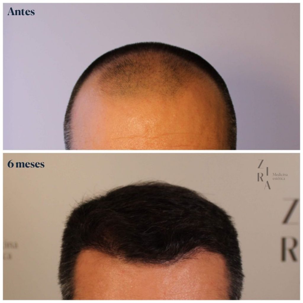 Recuperar el pelo de las entradas con injerto capilar