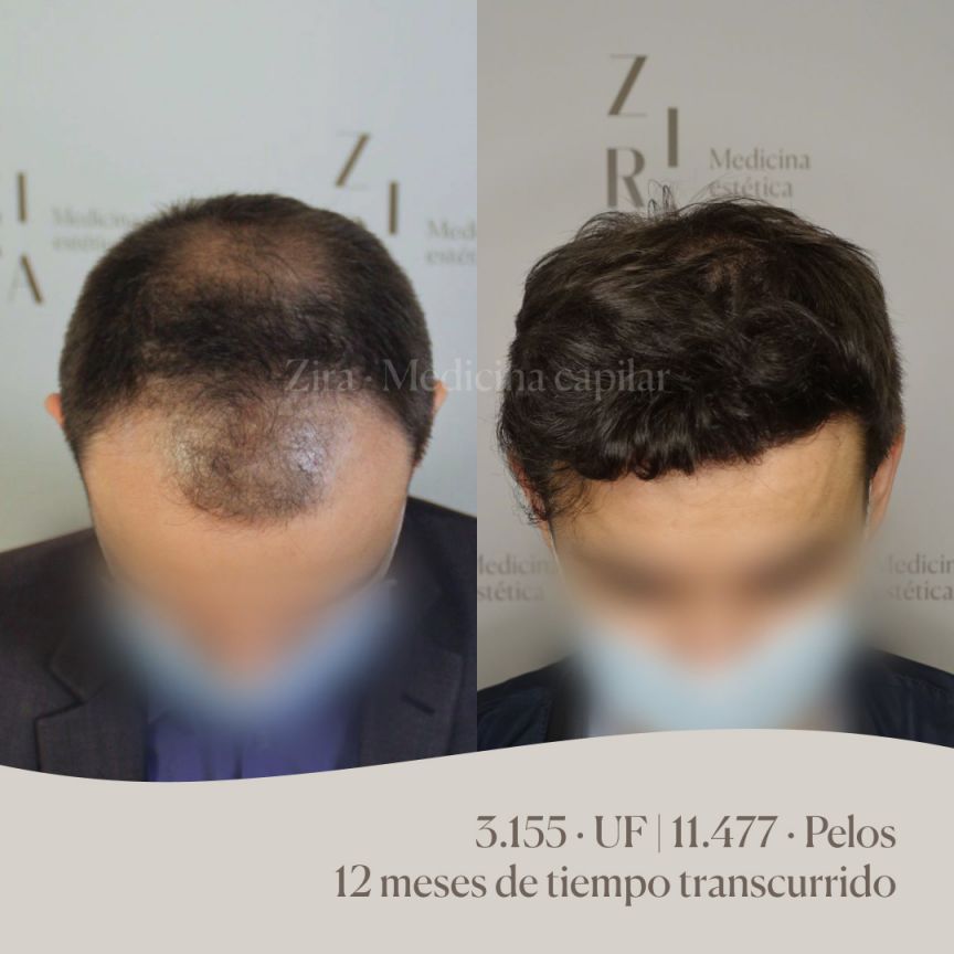 transplante de cabello, paciente de Valencia