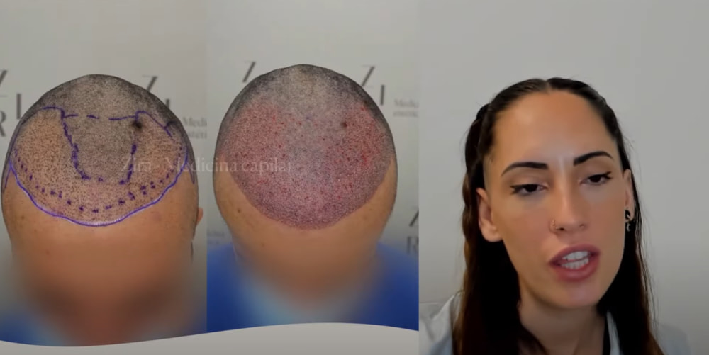 Transplante de pelo mal hecho, antes y despues