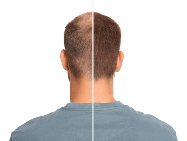 Tratamientos médicos para la mejora de la alopecia difusa