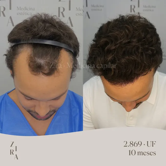 evolucion injerto capilar antes y despues